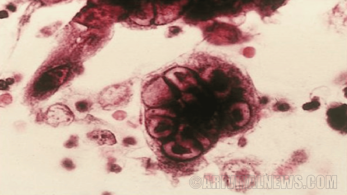 A sexually transmitted infection