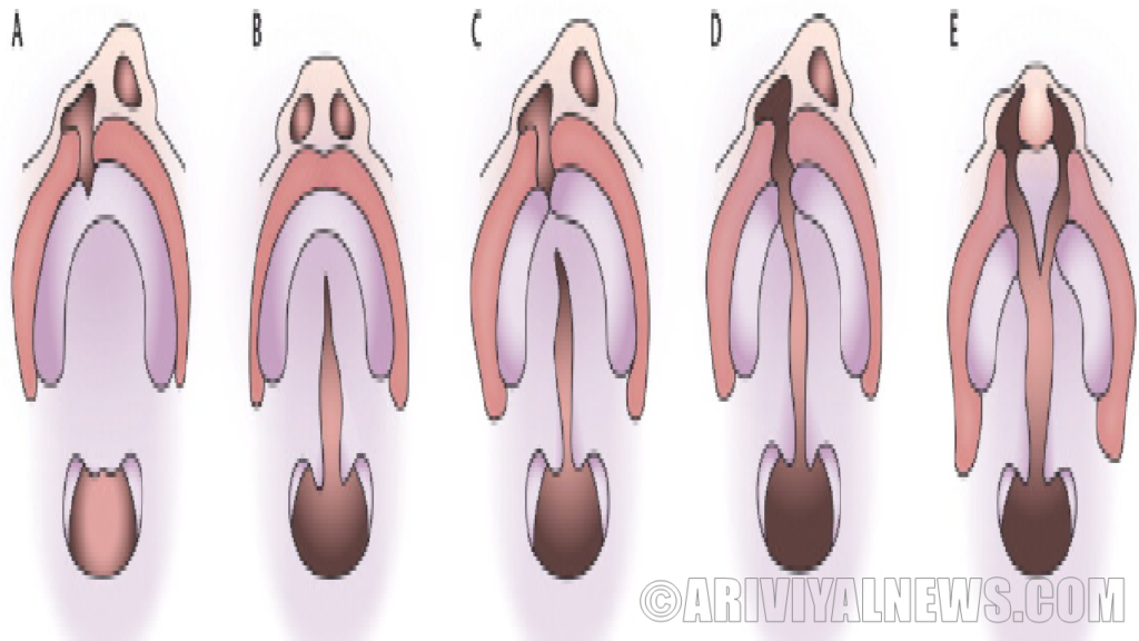 A cleft lip is caused by genes and environment