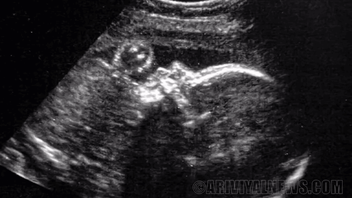 Brain surgery for a fetus in the womb