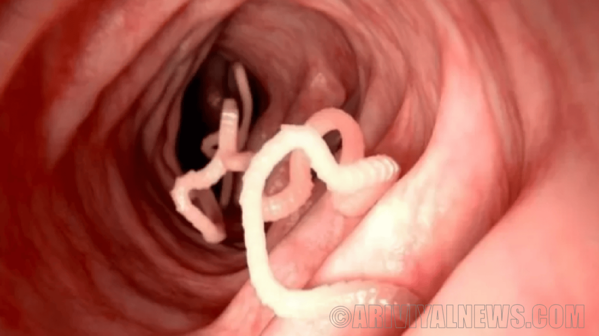 Human parasitic worm infections Human parasitic worm infections