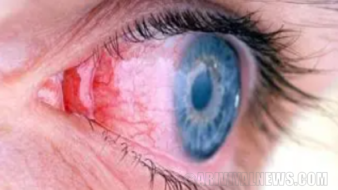 Diabetic prevents eye disease