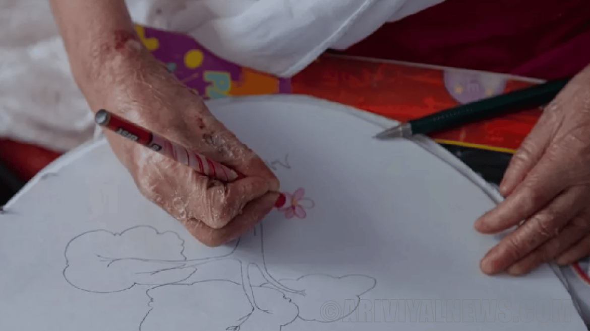 The new gene therapy gel approved for butterfly disease